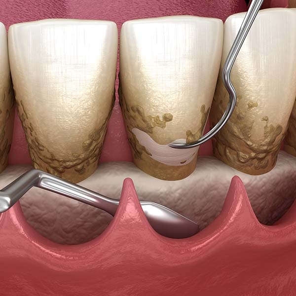Deep Teeth Cleaning Illustration