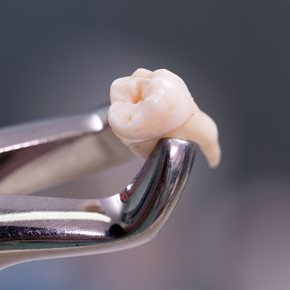 close-up of an extracted tooth being held with dental tools
