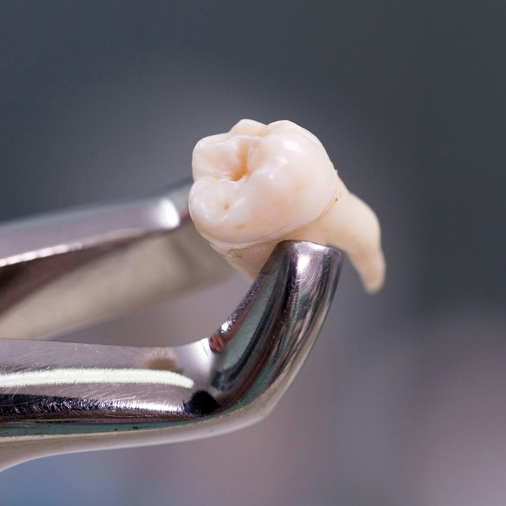 close-up of an extracted tooth being held with dental tools