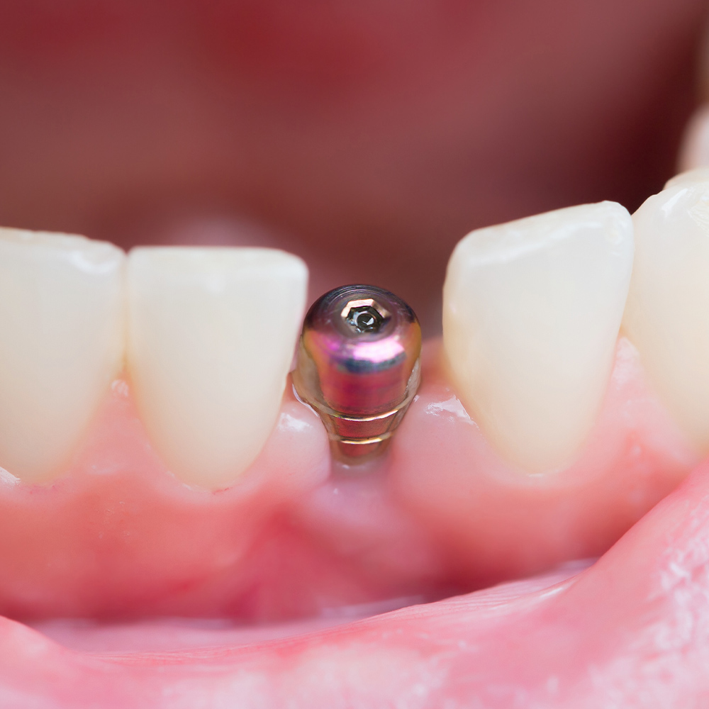 Close-up of tooth implant screw implanted in gums without crown