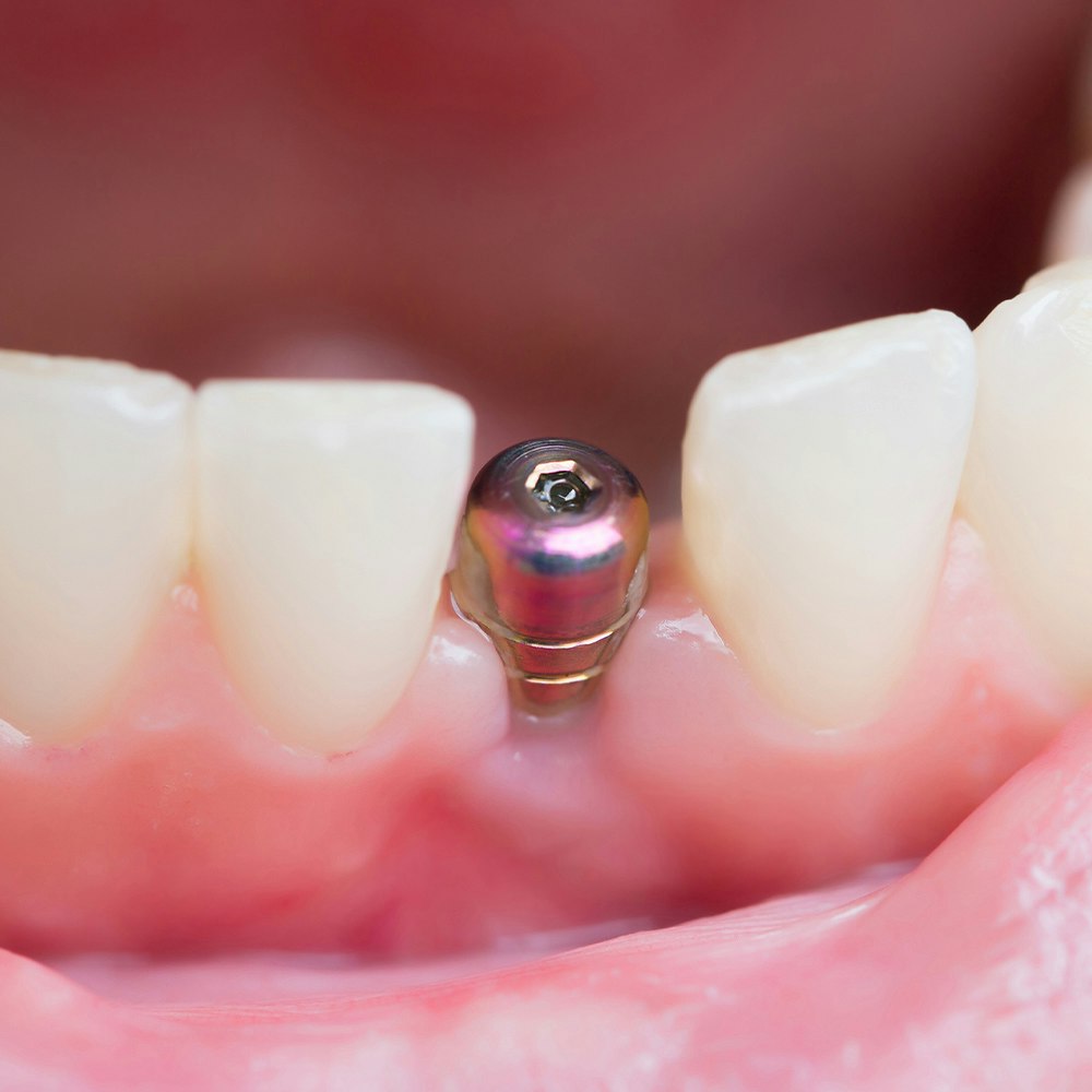 Close-up of tooth implant screw implanted in gums without crown