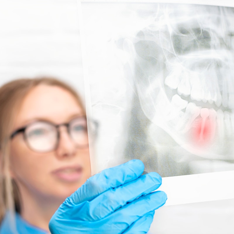 Vancouver, BC, dentist reviewing imaging of a tooth needing extraction