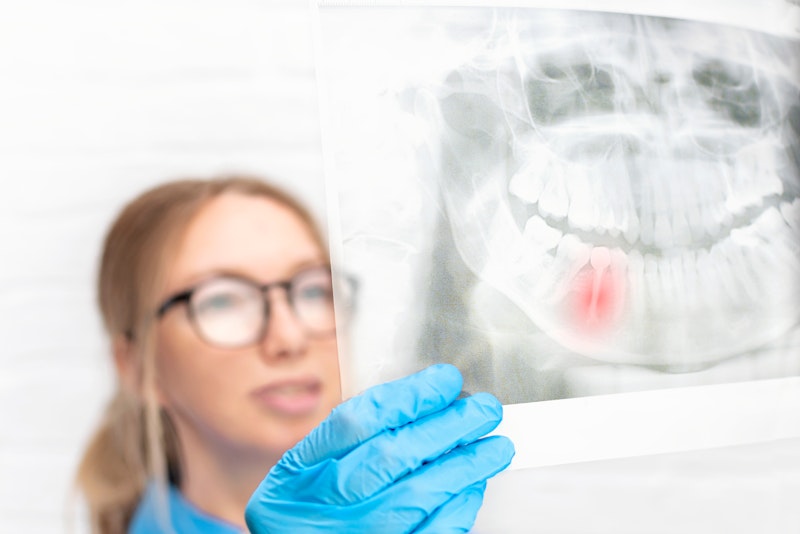 Vancouver, BC, dentist reviewing imaging of a tooth needing extraction