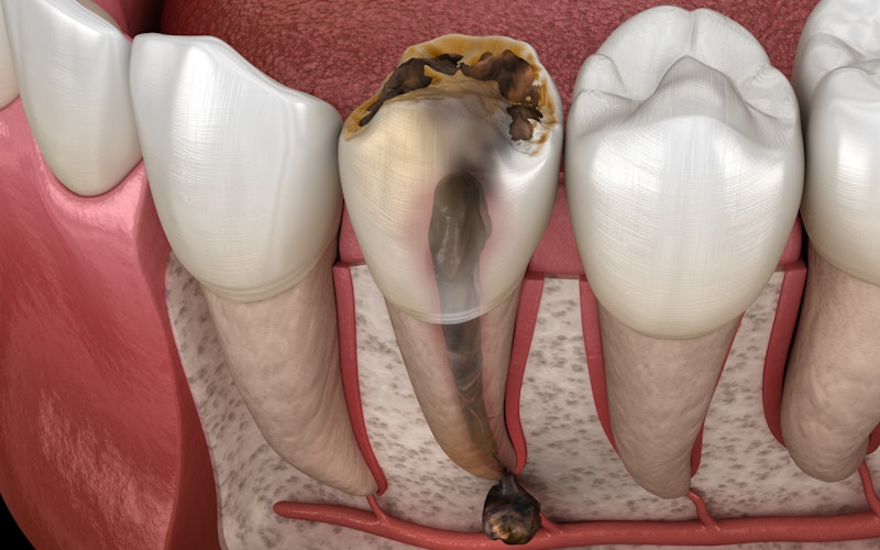 Illustration of tooth decay (pulp becomes infected, plaque builds up and destroys the enamel, bacteria forms an abscess, and infection can spread to the bloodstream)