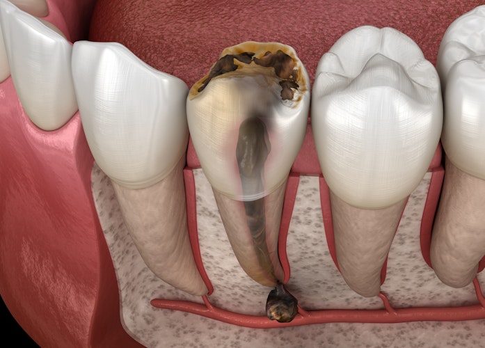 Illustration of tooth decay (pulp becomes infected, plaque builds up and destroys the enamel, bacteria forms an abscess, and infection can spread to the bloodstream)