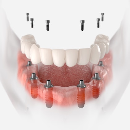 Illustration of an implanted-supported dentures