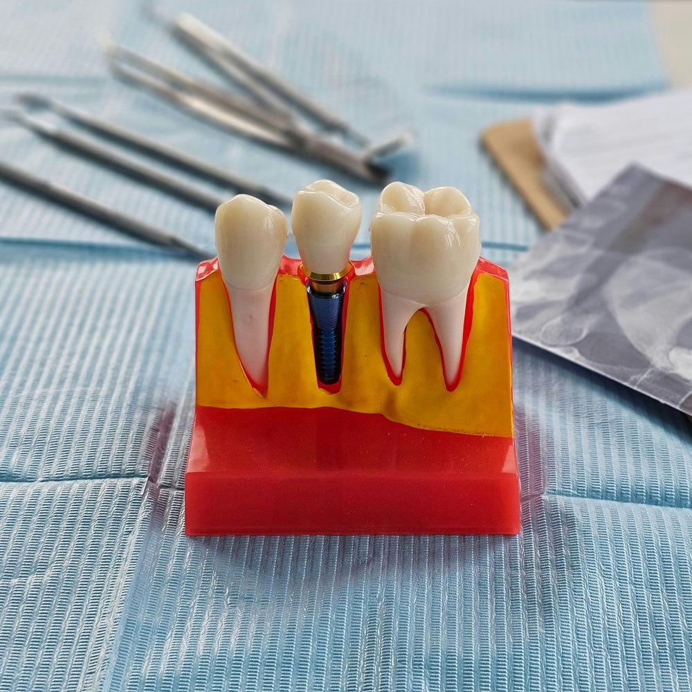 dental implant model