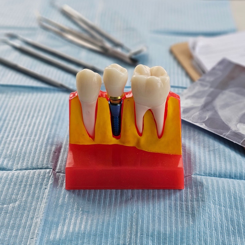 Dental implant in model of jaw
