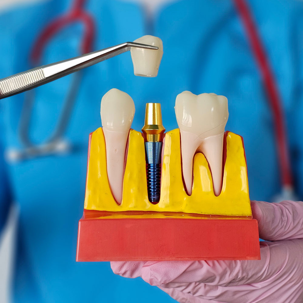 Image of an implant-supported dental bridge