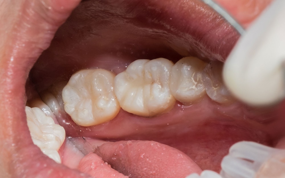 Examining a white filling on a molar