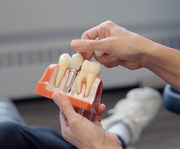 dental implant model