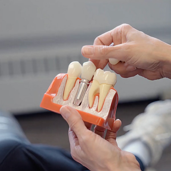 dental implant model