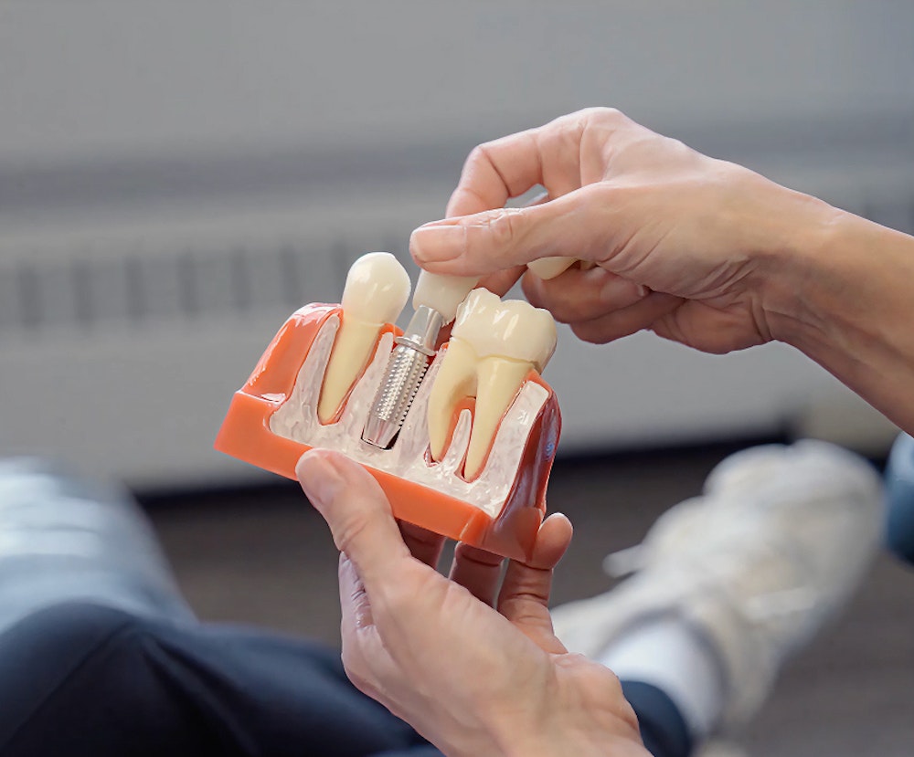 Dental Implant model