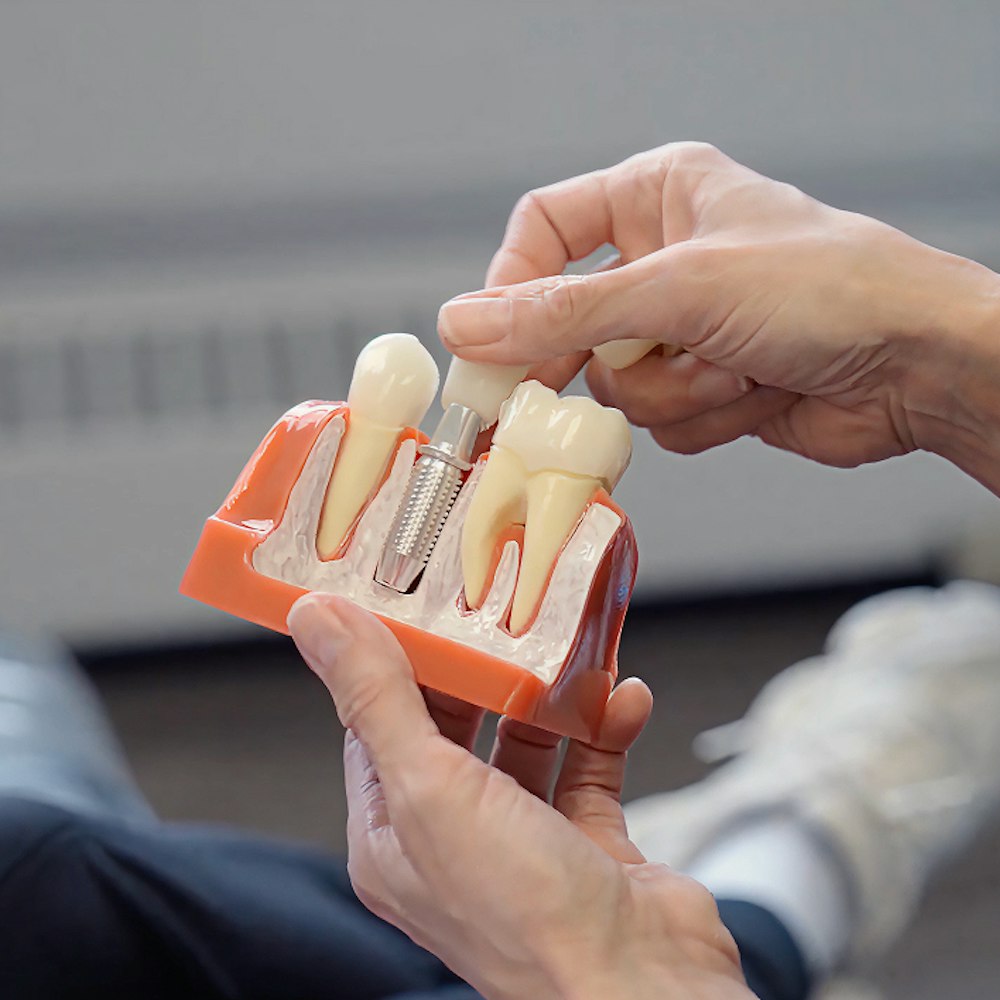Dental Implant model
