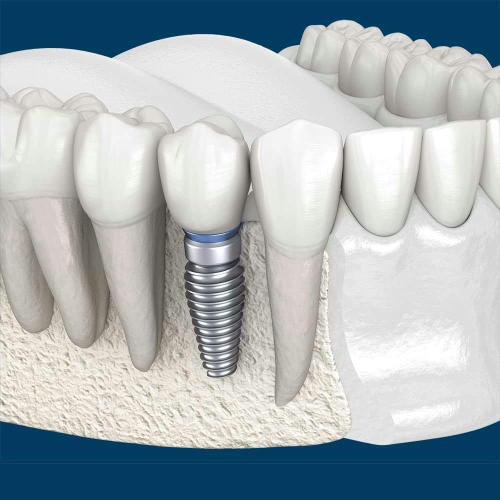 Side view of implant in jaw