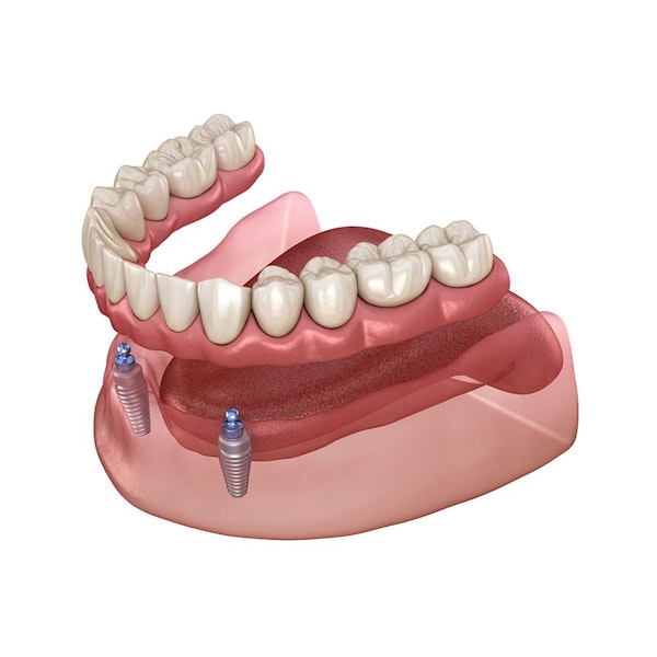 illustration of implant-supported denture