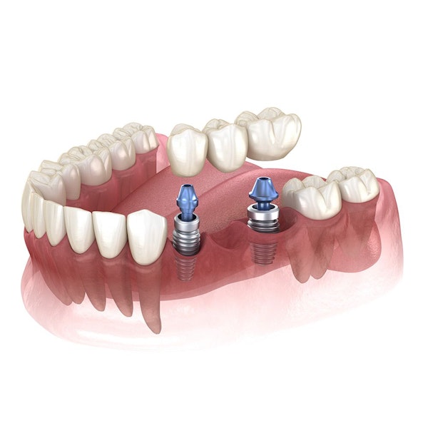 illustration of implant-supported bridge