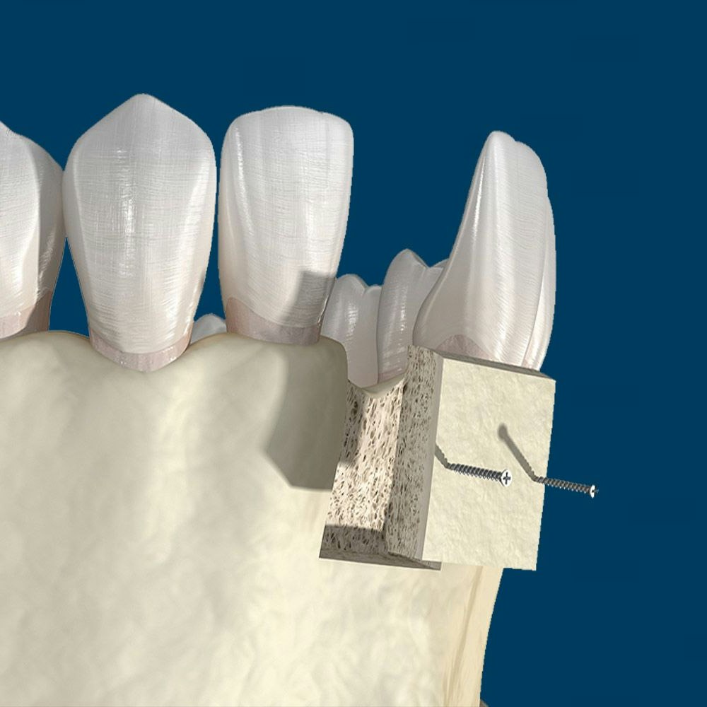 Bone graft
