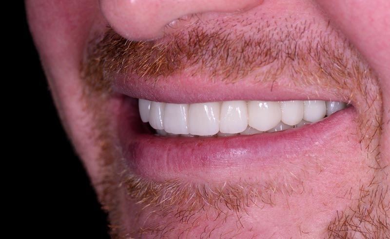 Patient after dental implants