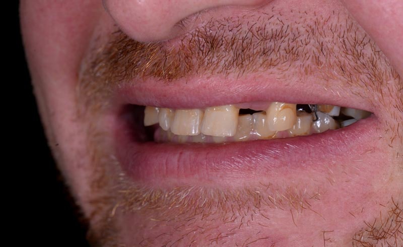 Patient before dental implants