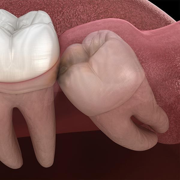 Impacted wisdom tooth
