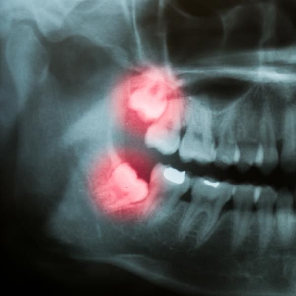 X-ray showing impacted wisdom teeth