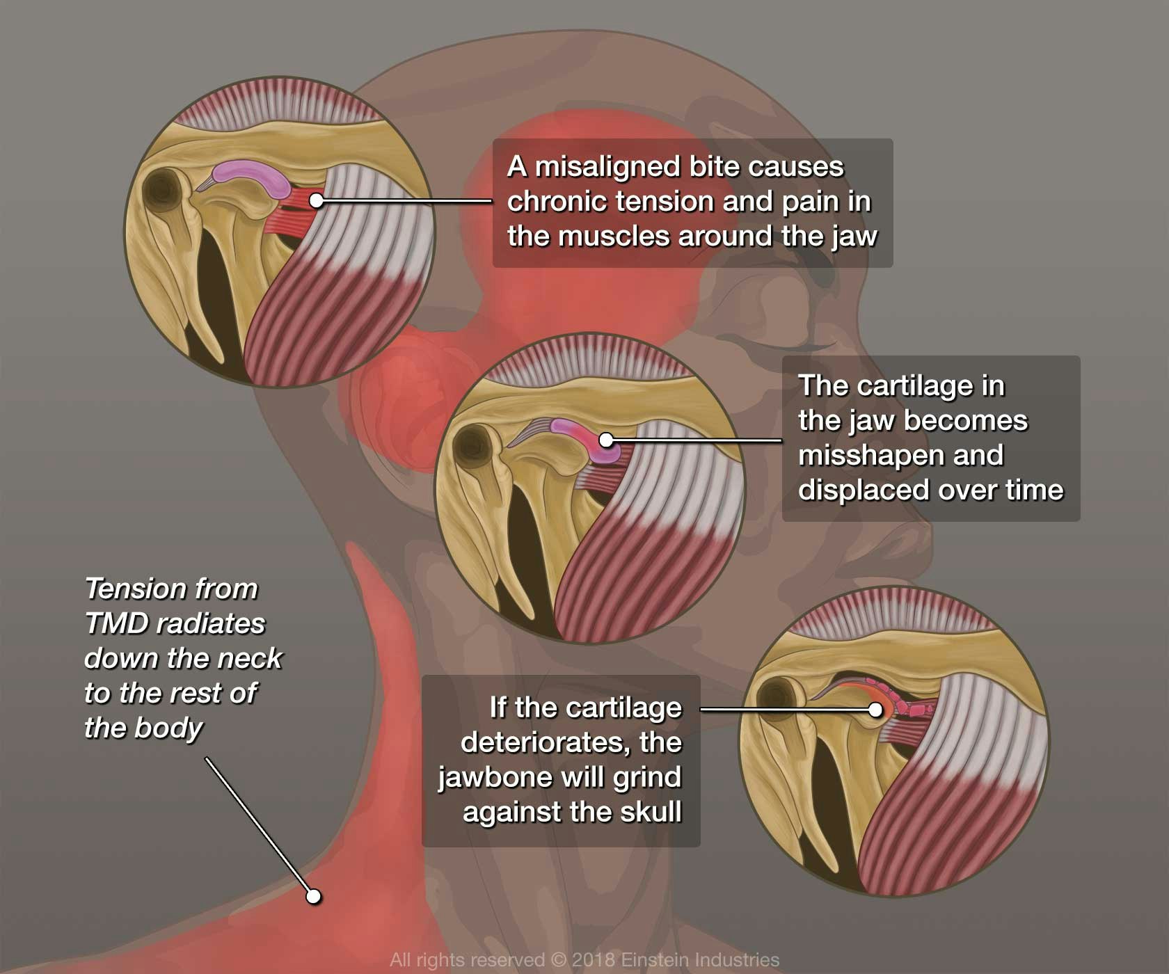 A misaligned bite causes chronic tension and pain in the muscles around the jaw. Tension from TMD radiates down the neck to the rest of the body. The cartilage in the jaw becomes misshapen and displaced over time. If the cartilage deteriorates, the jawbone will grind against the skull.