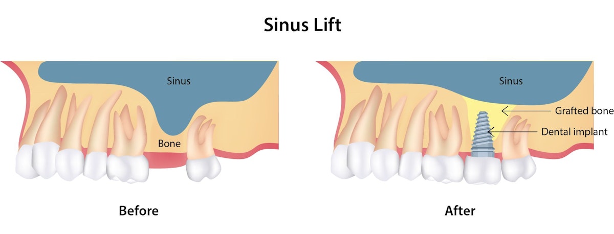 Diagram of before and after a sinus lift, where the bone is grafted, the sinus is lifted, and a dental implant is added