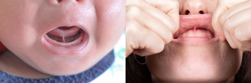 Tongue- and lip-tied patients