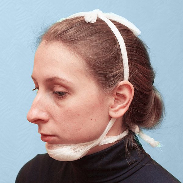 woman in jaw bandage