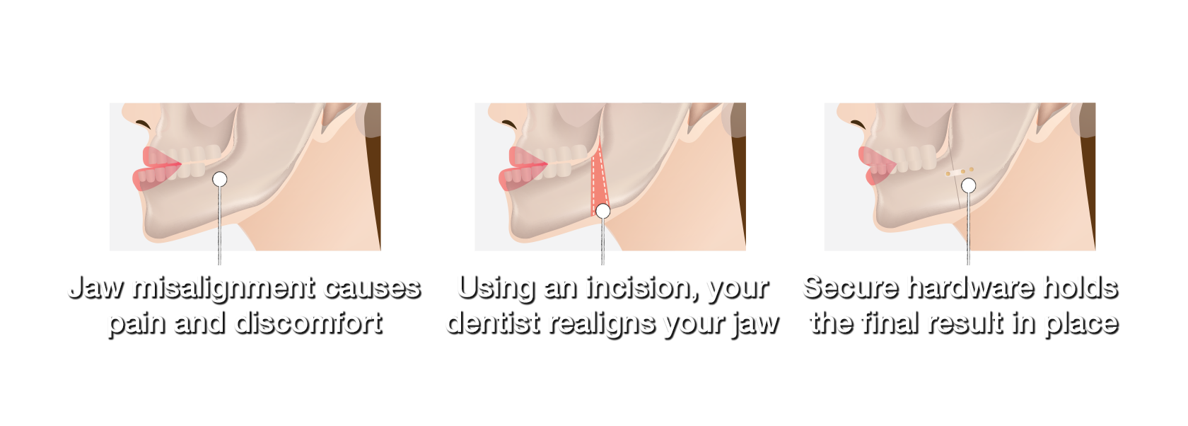 Jaw misalignment causes pain and discomfort. Using an incision, your dentist realigns your jaw. Secure hardware holds the final result in place.