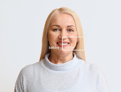 Woman before and after smile makeover