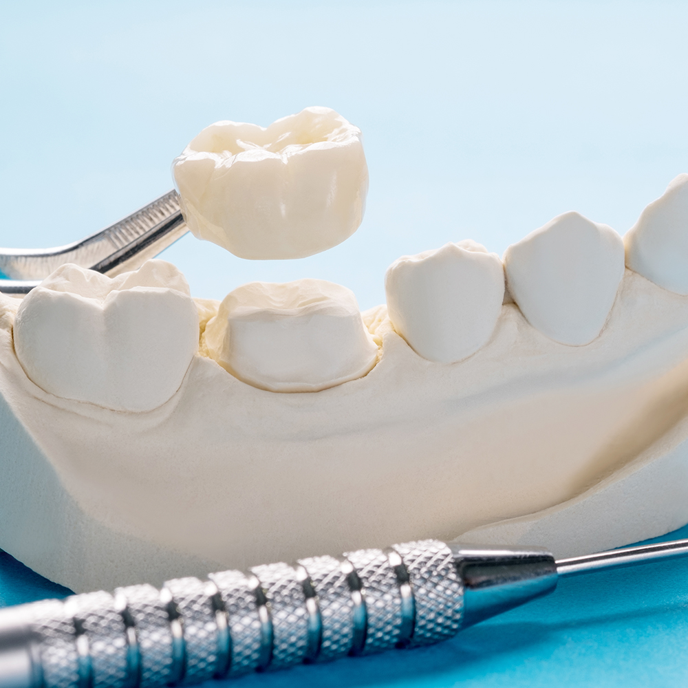 dental crown
