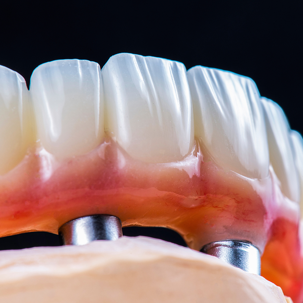 Close up of implant dentures