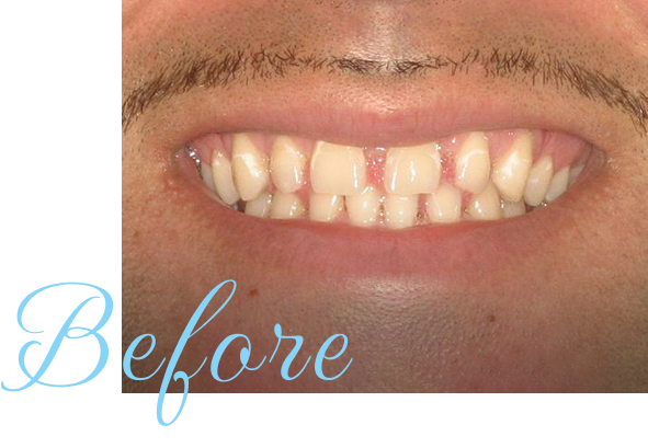 Virginia Beach patient before treatment