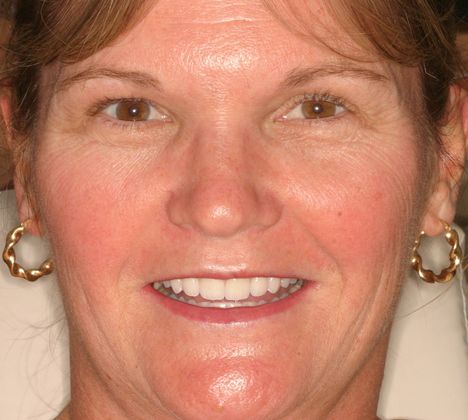 Margie After veneers