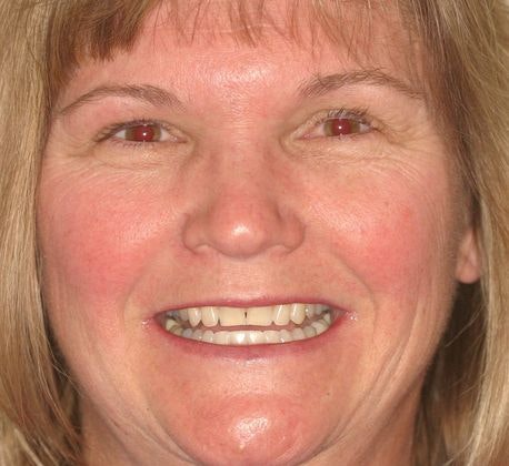 Margie Before veneers