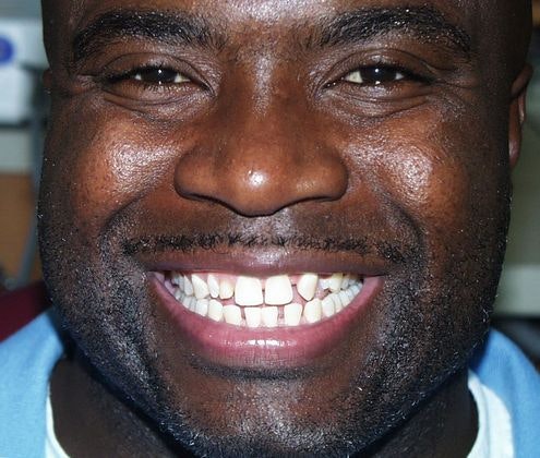 Rodney Before veneers