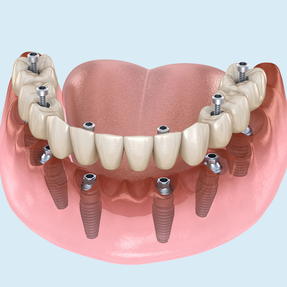 All-on-4 denture
