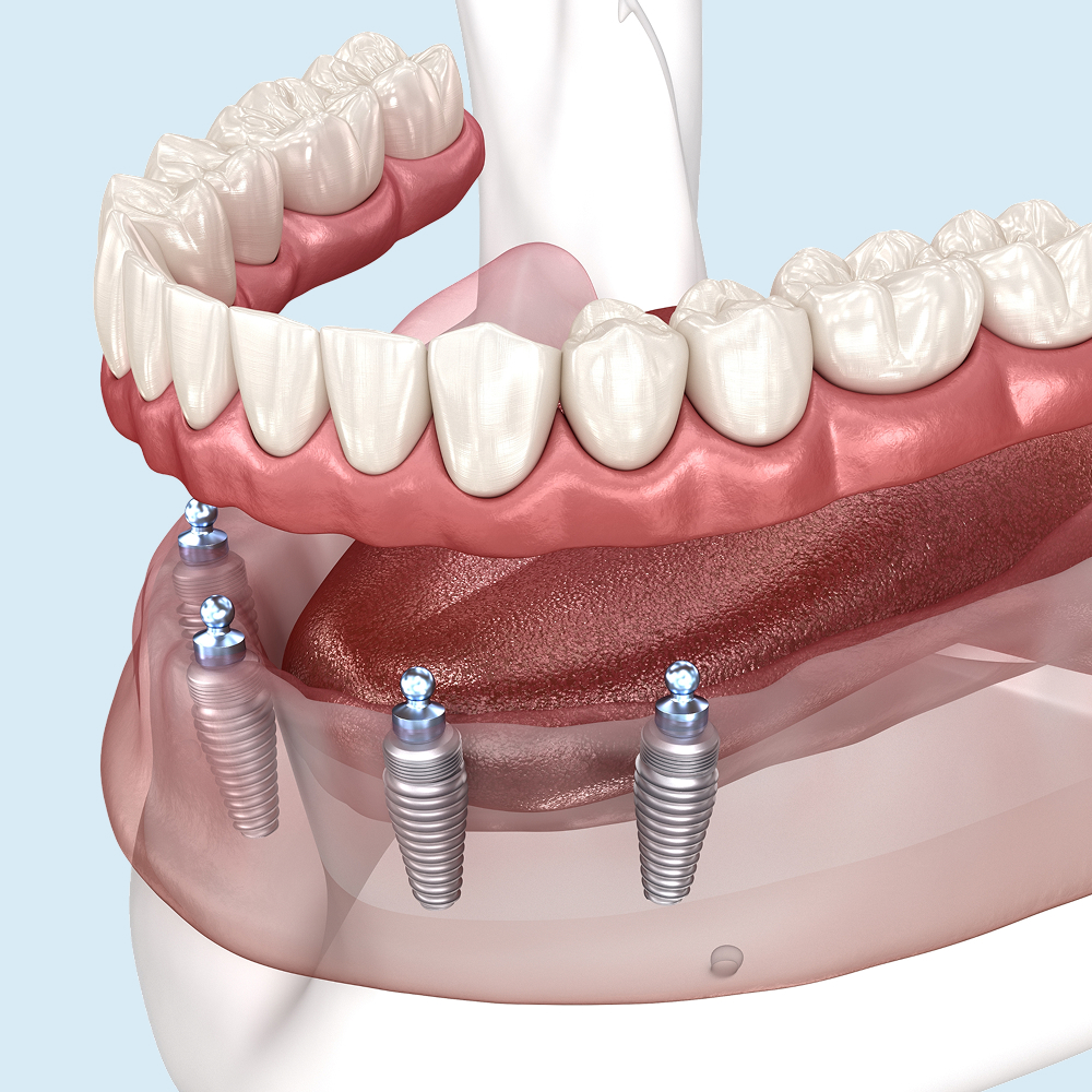 Close up of implant dentures