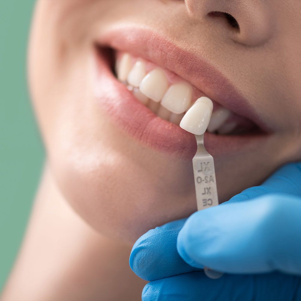 Veneers compared to natural teeth