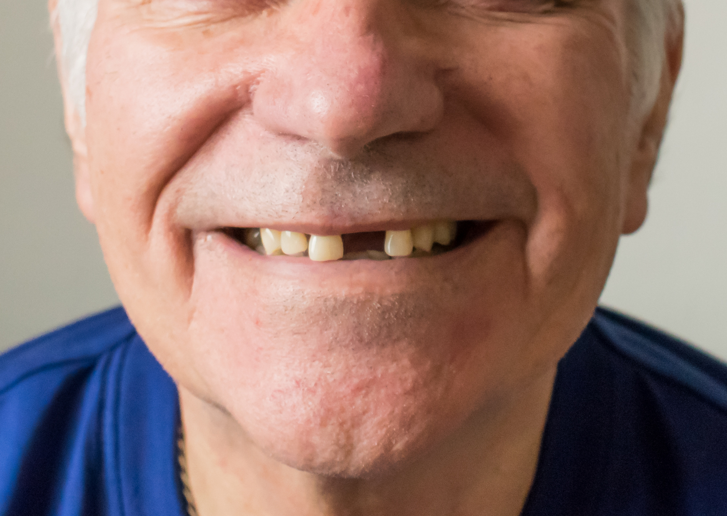 mature man with missing front tooth