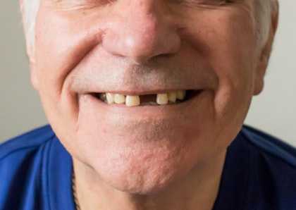 mature man with missing front tooth