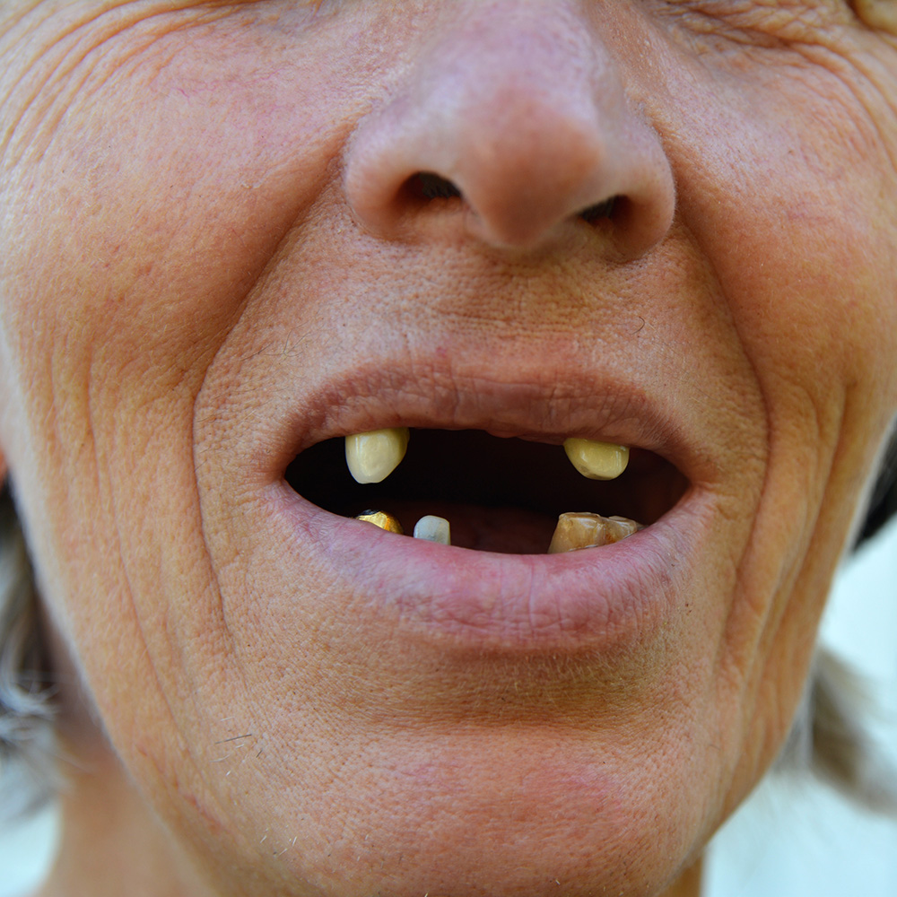 woman with multiple missing teeth in a row