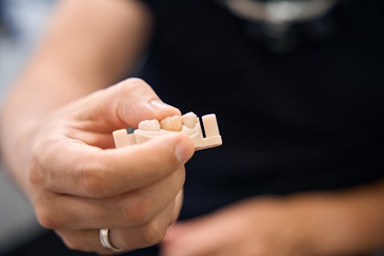 dentist placing crown on a model