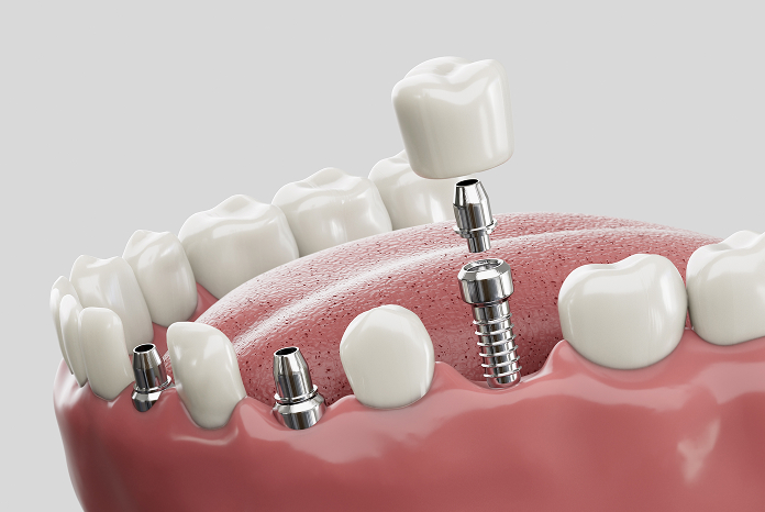 Dental implants
