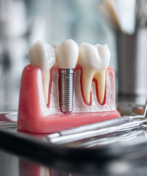 Model of an implant crown