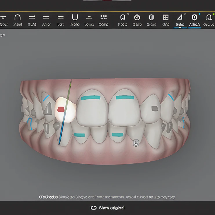 digital tooth model