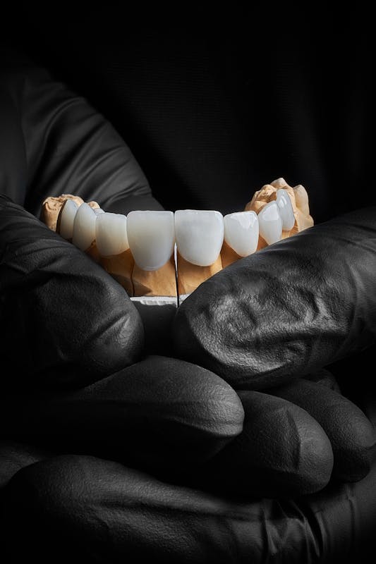 veneers on model dental arch