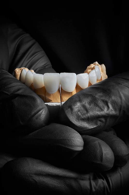 veneers on model dental arch